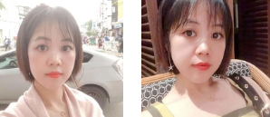 去眼袋手术