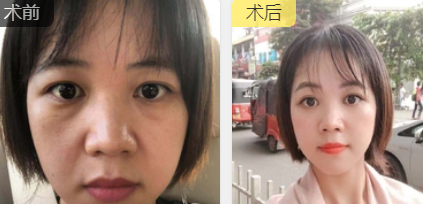 去眼袋手术