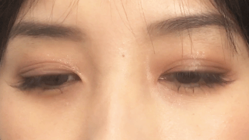 去眼袋手术