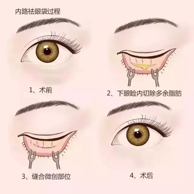 去眼袋手术