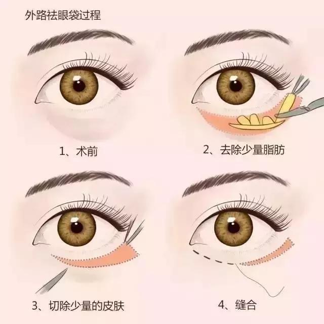 去眼袋手术