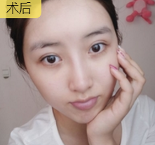 超声波去眼袋