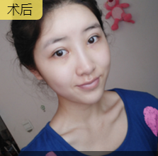超声波去眼袋