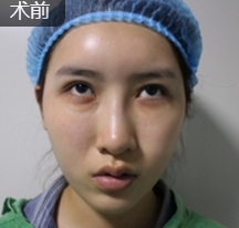 超声波去眼袋