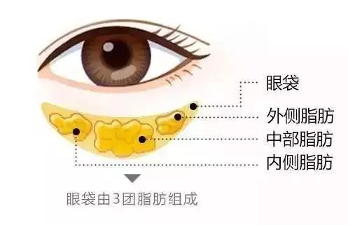 去眼袋手术
