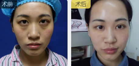 去眼袋手术