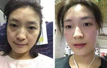 去眼袋手术