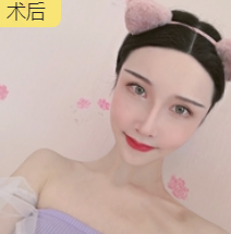 去眼袋手术