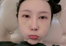 去眼袋手术