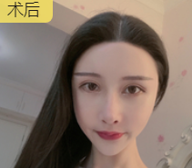去眼袋手术