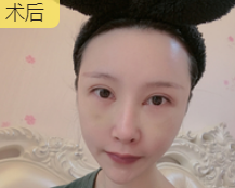 去眼袋手术