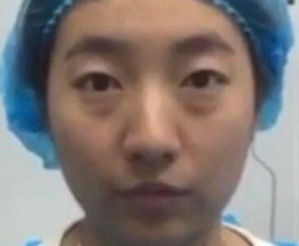 去眼袋手术