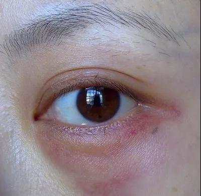 去眼袋手术