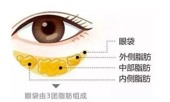 去眼袋手术