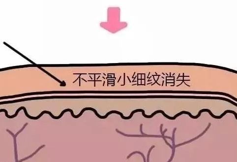 去眼袋手术