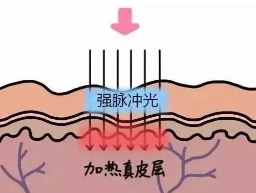 去眼袋手术