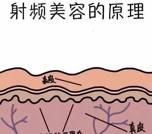去眼袋手术