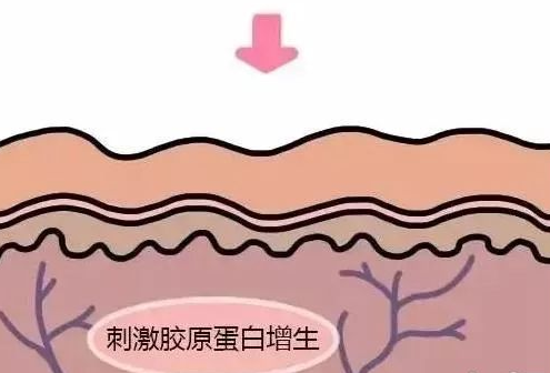 去眼袋手术