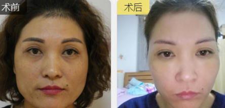 去眼袋手术