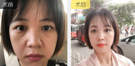 去眼袋手术
