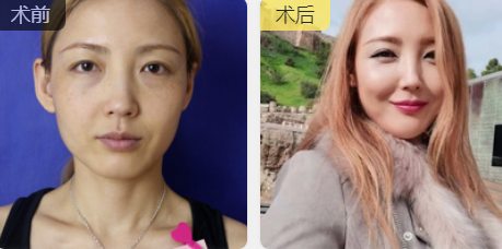 去眼袋手术