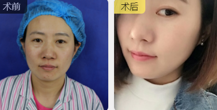 去眼袋手术