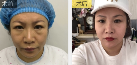 去眼袋手术