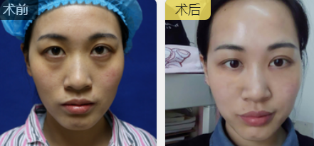 去眼袋手术