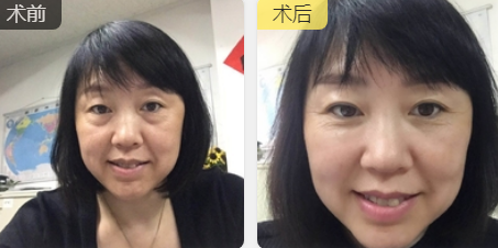 去眼袋手术