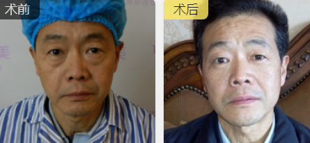 去眼袋手术