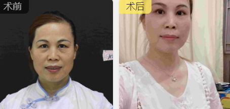 去眼袋手术
