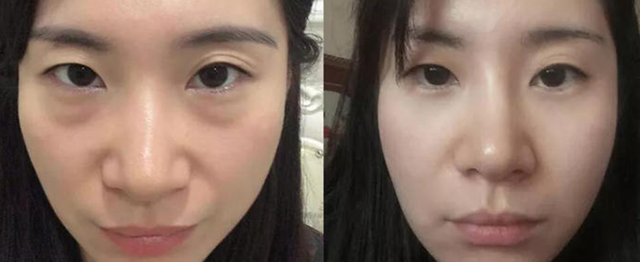 去眼袋手术