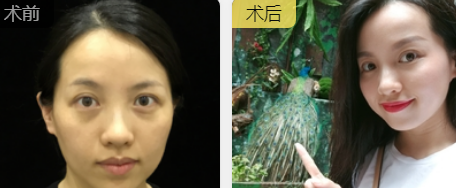 去眼袋手术