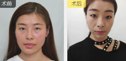 去眼袋手术