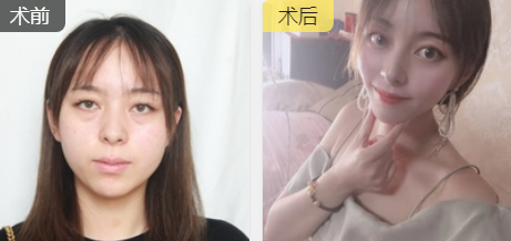 去眼袋手术