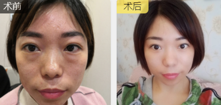 去眼袋手术