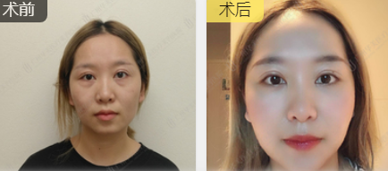去眼袋手术