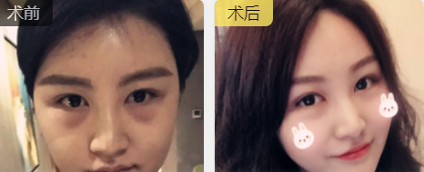 去眼袋手术