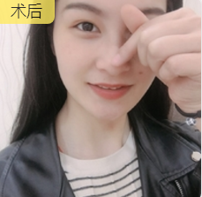 去眼袋手术