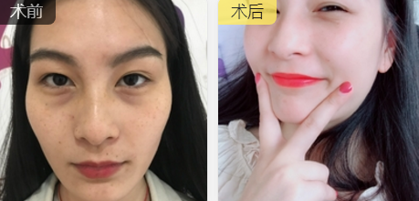 去眼袋手术