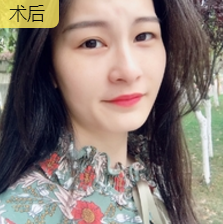 去眼袋手术