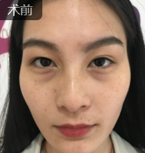 去眼袋手术