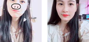 去眼袋手术