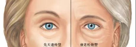 去眼袋手术