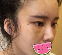 去眼袋手术