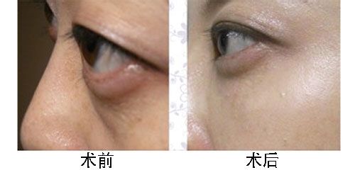 去眼袋手术