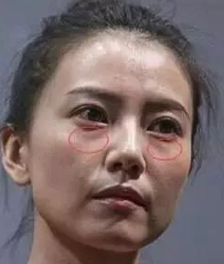 面部提升术