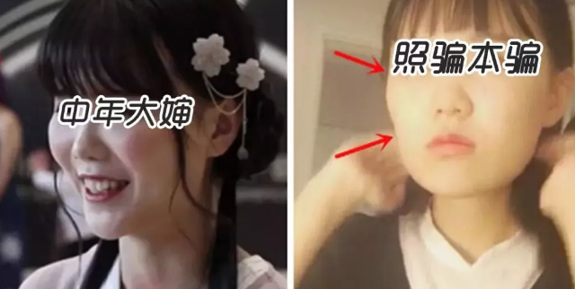 面部提升术