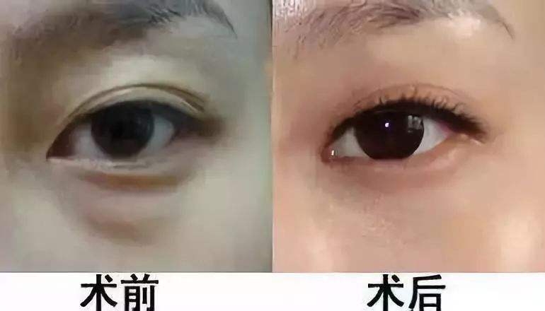 去眼袋手术