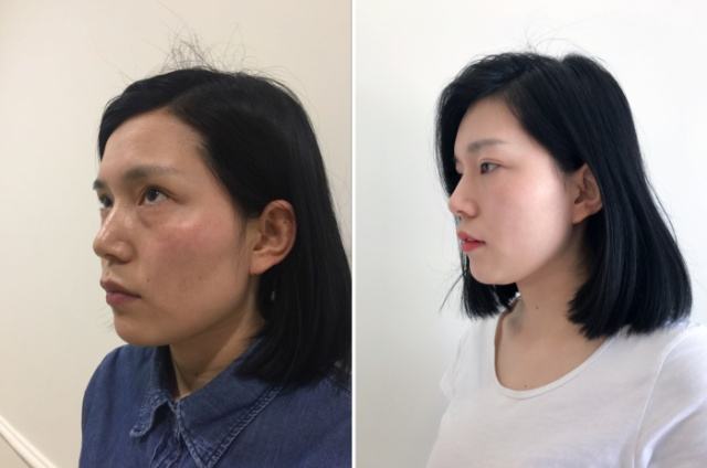 去眼袋手术